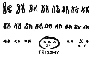 trisomy21.gif